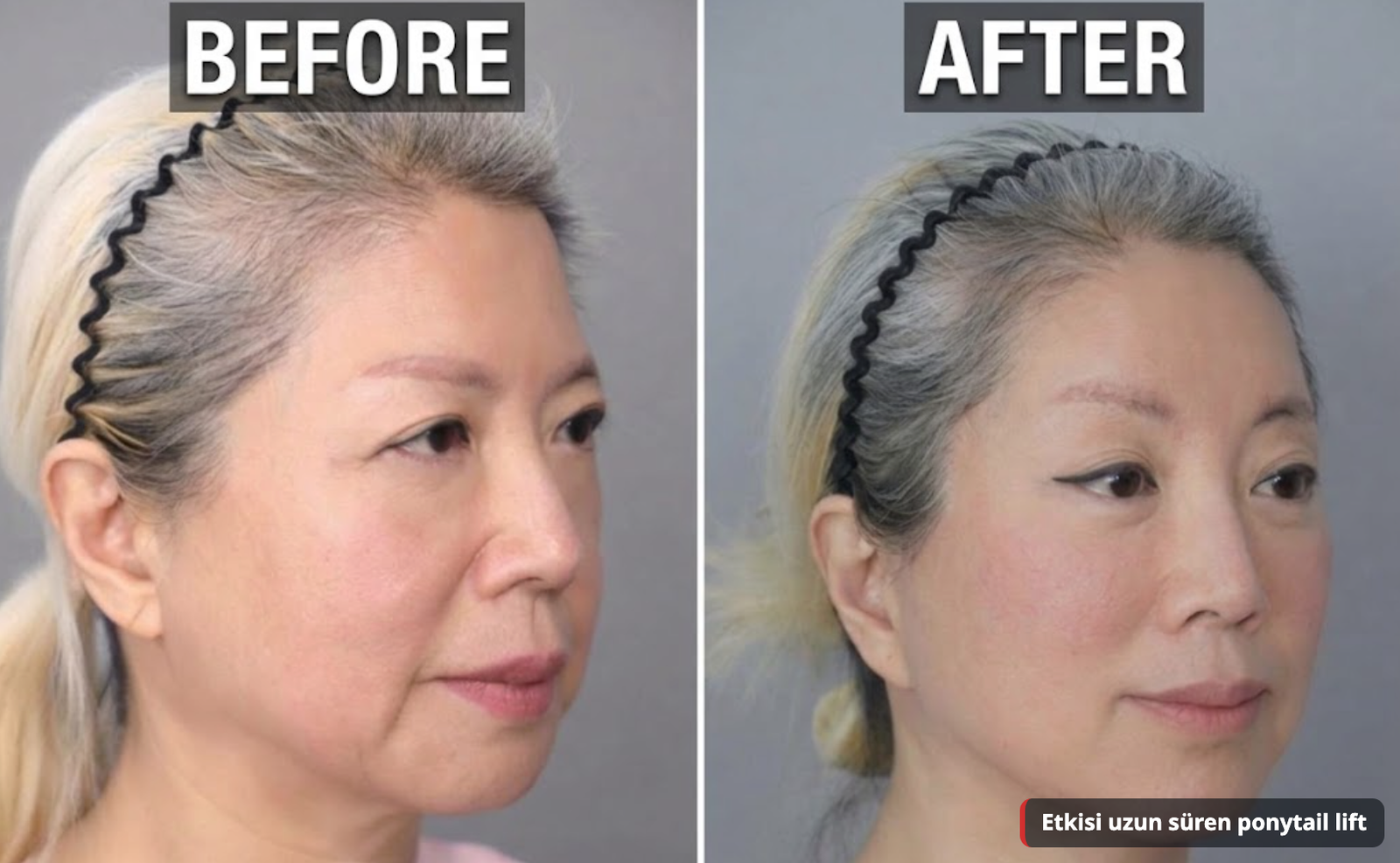 Üçlü periost serbestleştirmeli ponytail lift öncesi ve sonrası